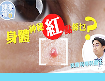 Haemangioma Dr Chan Yung Dermatologist