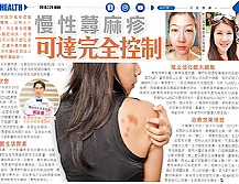 Urticaria